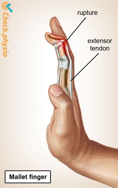 dropped hammer test medial|Mallet Finger .